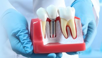 What is the Next Step After a Dental Implant is Placed?